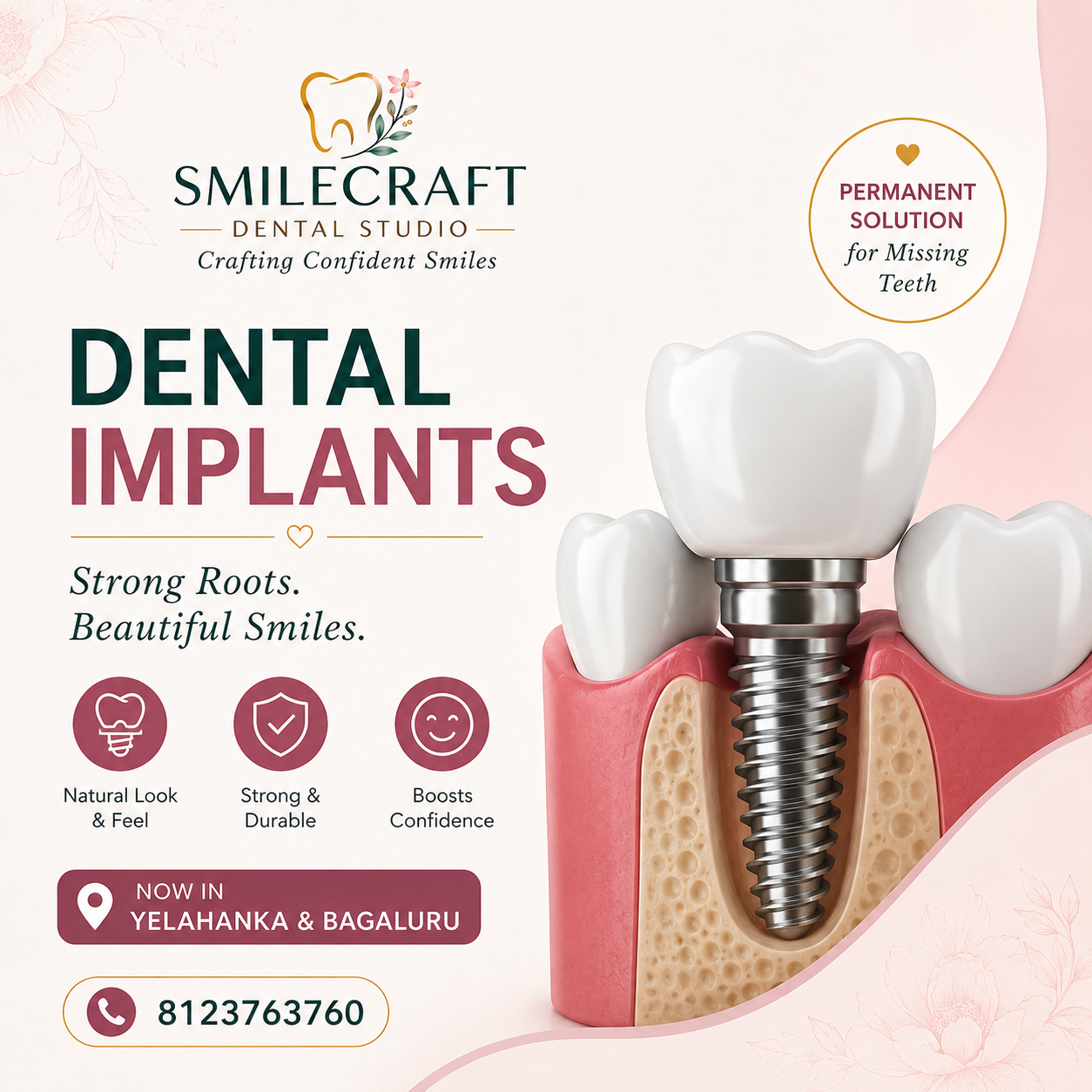 Best Dental Implants in Yelahanka & Bagaluru | SmileCraft Dental Studio